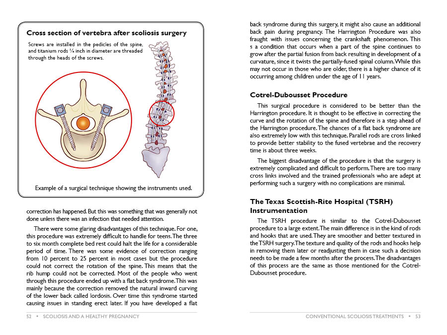 ScolioLife™ Scoliosis Specialist Surgery Clinic and Doctor in USA